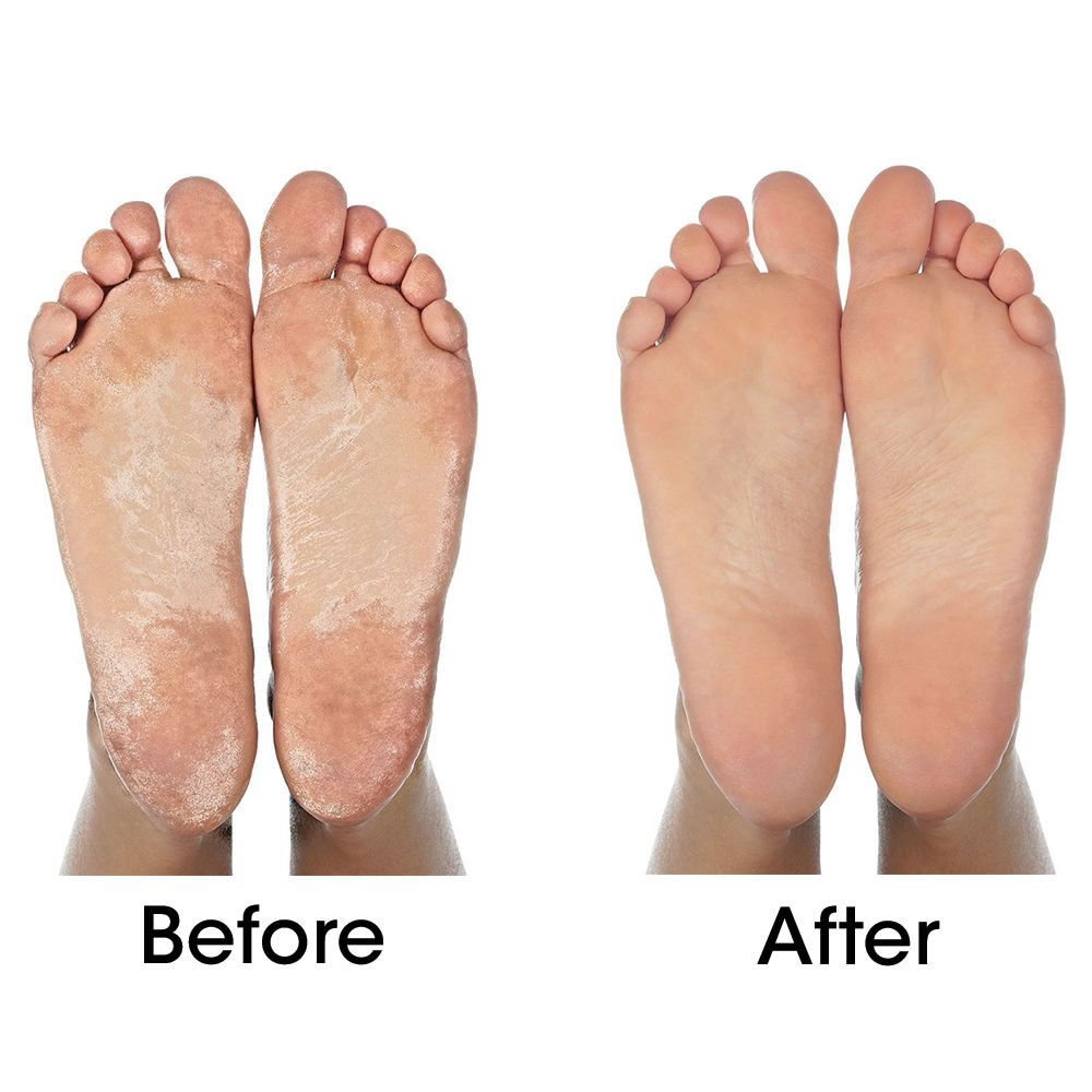 See Your Podiatrist for Callus Removal — Podiatry Group of